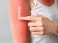 Mano applica crema su braccio arrossato dal sole, cercando rimedi per il prurito dopo abbronzatura.