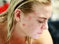 Primo piano del viso di una giovane donna con brufoli in gravidanza, che mostra la pelle arrossata e imperfezioni.