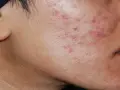 Primo piano del viso di un uomo con evidenti segni di acne ormonale maschile, arrossamenti e pustole sulla guancia e sul mento.