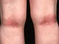 Gambe con arrossamento e ispessimento cutaneo, tipici della dermatite atopica.