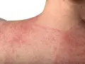 Estesa infiammazione della pelle con arrossamento e piccole pustole sul collo e sulla spalla.