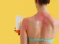 Schiena arrossata e dolente per una scottatura solare. Una crema solare a forma di cuore promette sollievo.