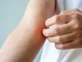 Mano che si gratta un braccio arrossato, possibile sintomo di prurito notturno cause.