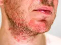 Primo piano di un uomo con dermatite viso, arrossamento e irritazione sulla barba e sul collo.