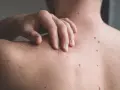 Mano che si gratta la schiena, coperta di nei. Un piccolo brufolo spunta su uno dei nei, un dettaglio inaspettato sulla pelle.
