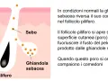 Illustrazione anatomica della pelle che spiega cosa sono i punti neri: il sebo ostruisce il follicolo pilifero.