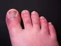 Dita dei piedi arrossate e gonfie, con segni di **geloni ai piedi**. La pelle appare secca e screpolata, soprattutto attorno alle unghie.