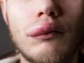 Primo piano di un uomo con un labbro gonfio e arrossato, forse a causa di una reazione allergica o un infortunio.