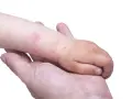 Braccio di bambino con chiazze rosse e squamose, sintomo di dermatite acuta, tenuto da una mano adulta.