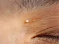 Un piccolo brufolo, simile a grani di miglio, appare sulla pelle rugosa vicino all'occhio.