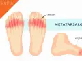 Illustrazione anatomica del piede che mostra la metatarsalgia, un dolore sotto le dita. Rimedi naturali per il dolore sotto le dita del piede.