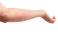 Braccio con eruzione cutanea rossa e pruriginosa, tipica dell'orticaria. Scopri come curarla.