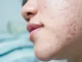 Primo piano del viso di una persona con brufoli pre ciclo, rossori e imperfezioni sulla guancia e sul mento.