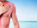 Uomo con forte eritema solare sul petto e spalla, mentre si applica una crema lenitiva. Il mare sullo sfondo ricorda l'estate.