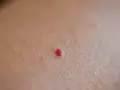 Piccola macchia rossa sulla pelle, tipo bruciatura, che prude.