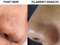 Confronto tra punti neri e filamenti sebacei sul naso. I filamenti sebacei appaiono come piccoli puntini chiari, mentre i punti neri sono più scuri e visibili.