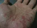 Mano con pelle secca, screpolata e arrossata, sintomo di disidrosi mani.