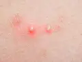 Due pustole sul corpo, rosse e gonfie, con la punta bianca, circondate da peluria sottile.