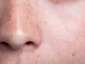 Primo piano del viso con ipomelanosi guttata. Si cercano rimedi per queste macchie cutanee.