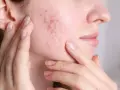 Primo piano del viso di una donna con brufoli sul viso, che si tocca la guancia. Capire perchè vengono i brufoli è il primo passo per una pelle sana.