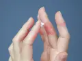 Mani con dermatite dita: pelle arrossata, screpolata e con piccole lesioni. Una mano applica crema.