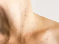 Pelle chiara con numerose macchie solari e lentiggini sul collo e sulle spalle. Alcune macchie solari vanno via da sole, altre rimangono.