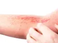 Braccio con eruzione cutanea rossa e puntini, possibile micosi dermatite da stress senza prurito.
