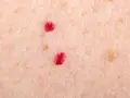 Primo piano della pelle con due angiomi rubino. Si cercano angioma rubino rimedi naturali per attenuare queste piccole macchie rosse.