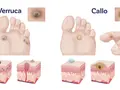 Illustrazione comparativa di verruche e calli, mostrando i diversi tipi e le loro caratteristiche cutanee.