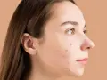Primo piano del viso di una giovane donna con brufoli. La domanda "quanto ci mette un brufolo ad andare via" è centrale per chi soffre di acne.