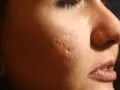 Primo piano del viso di una persona con evidenti cicatrici da acne, simili a macchie varicella, sulla guancia.