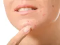 Dito, come non schiacciare i brufoli: un dito indica un brufolo sul viso, vicino alla bocca.