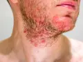 Primo piano del collo di un uomo con irritazione e brufoli sul collo, rossore e peli della barba.
