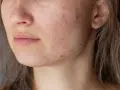 Primo piano del viso di una giovane donna con pelle arrossata e imperfezioni, tipiche dell'acne aestivalis.