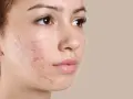 Primo piano del viso di una giovane donna con evidenti bollicine sul viso, segno di acne.