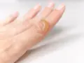 Dito, una bolla da scottatura su un dito, segno di un contatto accidentale con calore.