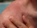 Spalla arrossata e irritata, con piccoli puntini rossi. Potrebbe essere necessario cercare rimedi eritema solare.