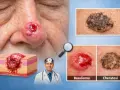 Basalioma sul naso, con sezione anatomica e confronto con cheratosi, una macchia scura dopo crosta.