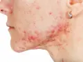Primo piano del viso di una persona con acne, con un brufolo che non va via e arrossamenti evidenti.