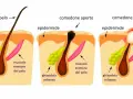 Illustrazione che spiega perchè escono i brufoli: un poro ostruito da sebo e cellule morte causa infiammazione.