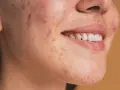 Primo piano del viso di una persona con vari tipi di brufoli e imperfezioni sulla pelle.