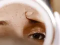 Dito un dito preme sulla fronte, evidenziando un piccolo buco nella pelle dopo brufolo, tra altre imperfezioni.