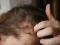 Dita che grattano un cuoio capelluto arrossato e dolorante, con evidenti squame bianche tra i capelli castani.