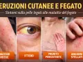 Eruzioni cutanee, ittero e angiomi stellati: sintomi del fegato. Per il prurito insopportabile rimedi sono necessari.