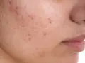 Primo piano di una guancia con diversi brufoli e pori dilatati, che evidenziano la texture della pelle.