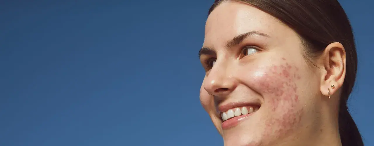 Primo piano di una giovane donna sorridente con pelle imperfetta, dove spicca un brufolo rosso.
