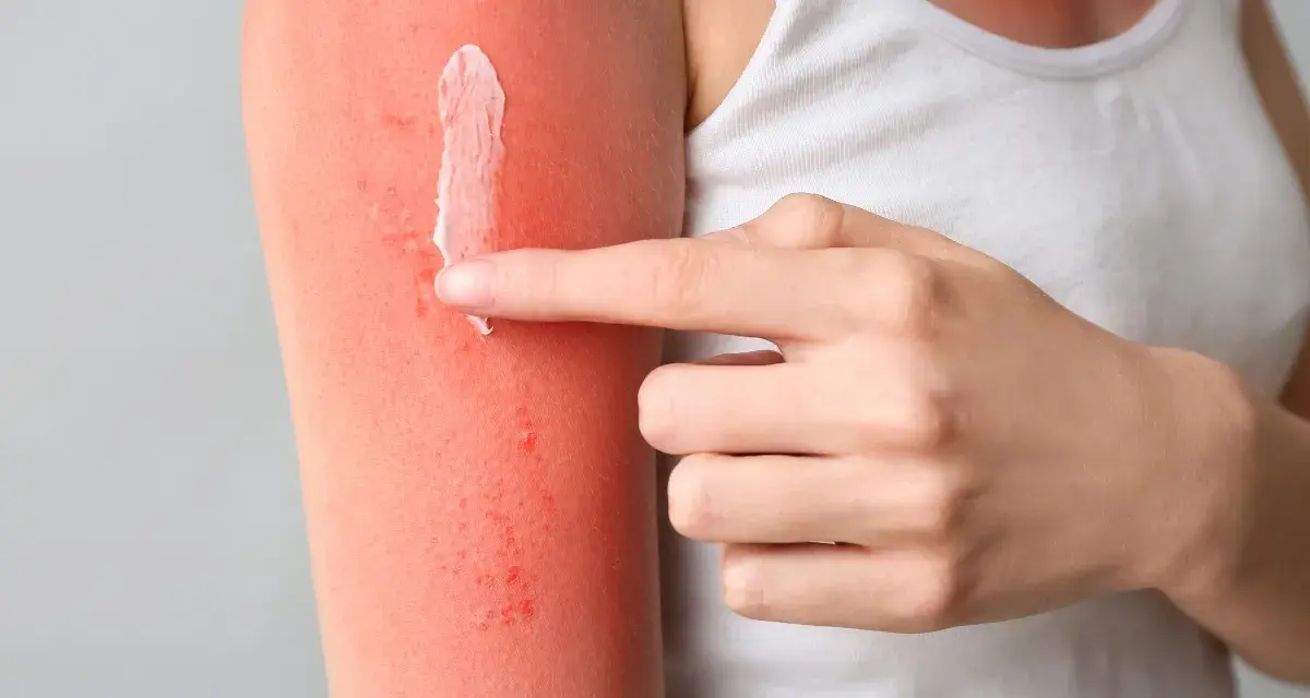 Mano applica crema su braccio arrossato dal sole, cercando rimedi per il prurito dopo abbronzatura.