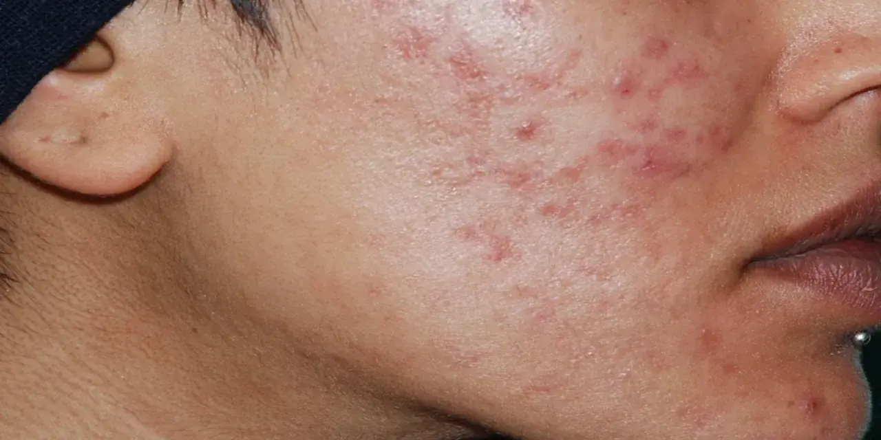 Primo piano del viso di un uomo con evidenti segni di acne ormonale maschile, arrossamenti e pustole sulla guancia e sul mento.