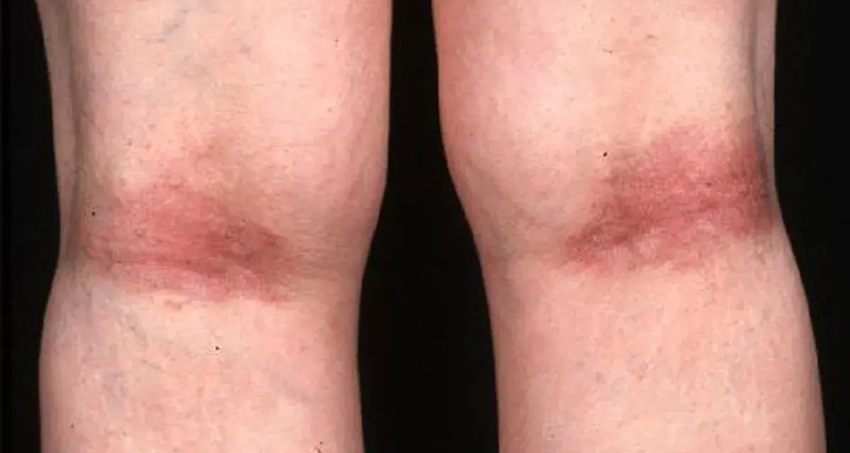 Gambe con arrossamento e ispessimento cutaneo, tipici della dermatite atopica.