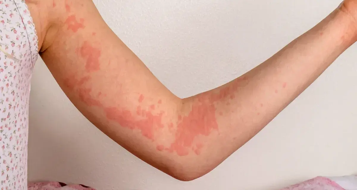 Braccia con eruzioni cutanee rosse e gonfie, segno di un forte prurito nervoso.